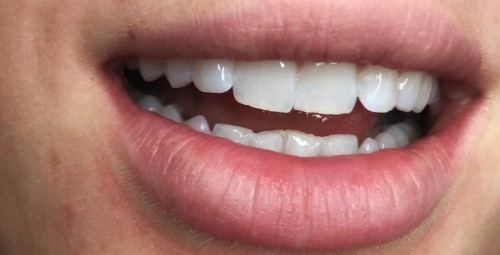 Фотоотбеливание зубов Тарту #4