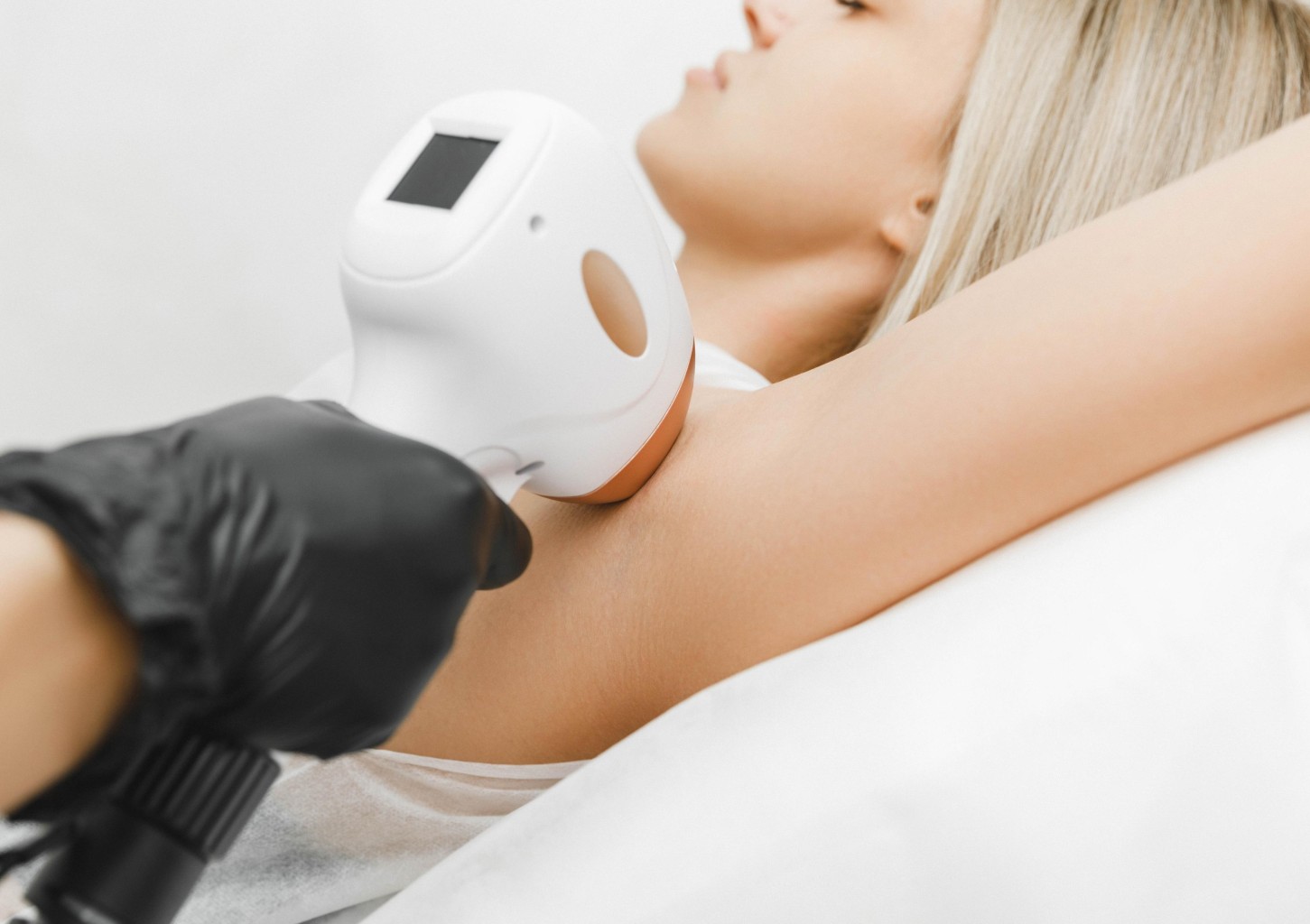 Kaenlaaluste laserepilatsioon