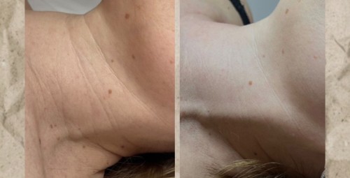 SQT микронедлинг #3