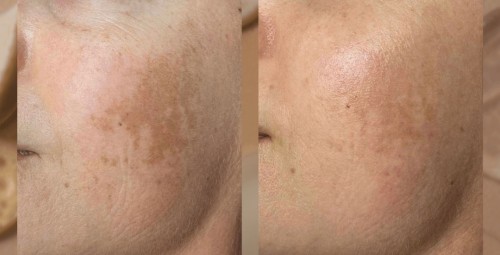 SQT микронедлинг #2