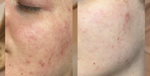 SQT микронедлинг #4