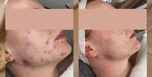 SQT микронедлинг #5